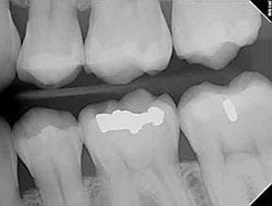 Digital Xray | Bellingham Dentist | Dental Implants | Northside Dental Care