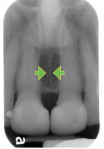 Green Arrows | Bellingham Dentist | Dental Implants | Northside Dental Care