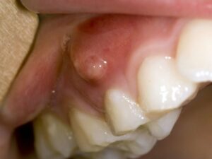 Gum Abscess | Bellingham Dentist | Dental Implants | Northside Dental Care