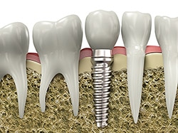 Implant Model | Bellingham Dentist | Dental Implants | Northside Dental Care