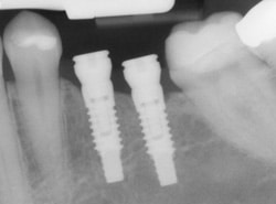 Implants X Ray | Bellingham Dentist | Dental Implants | Northside Dental Care