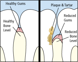 Periodontitis | Bellingham Dentist | Dental Implants | Northside Dental Care