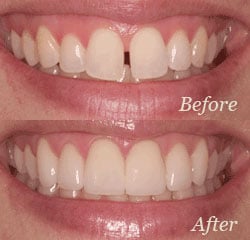 Veneers | Bellingham Dentist | Northside Dental Care