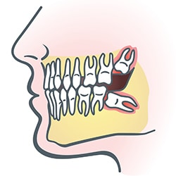 Wisdom Teeth Illus | Bellingham Dentist | Dental Implants | Northside Dental Care