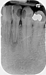 X Ray Of Abcess | Bellingham Dentist | Dental Implants | Northside Dental Care